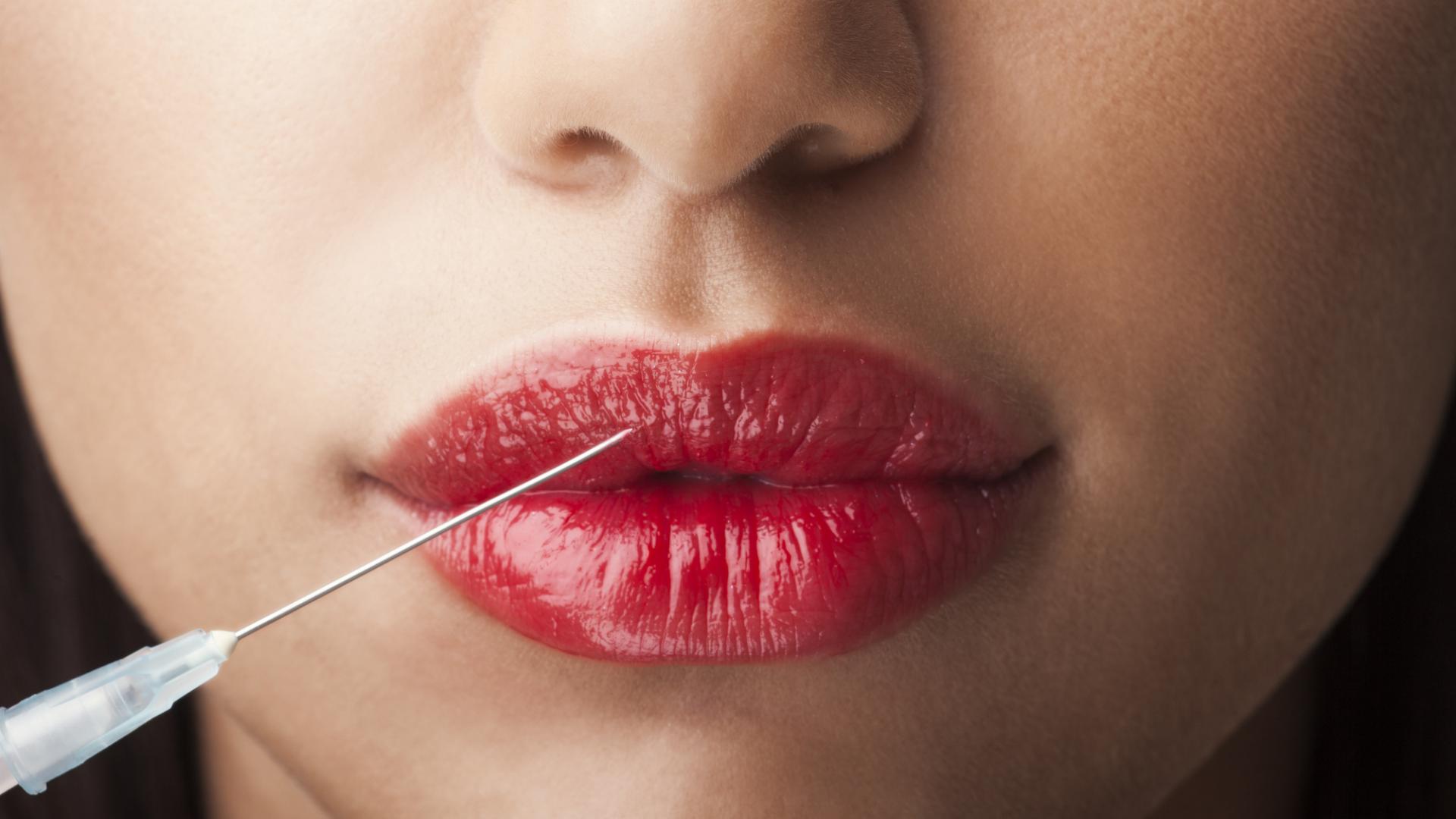 Botoxbehandlung Lippen aufspritzen
