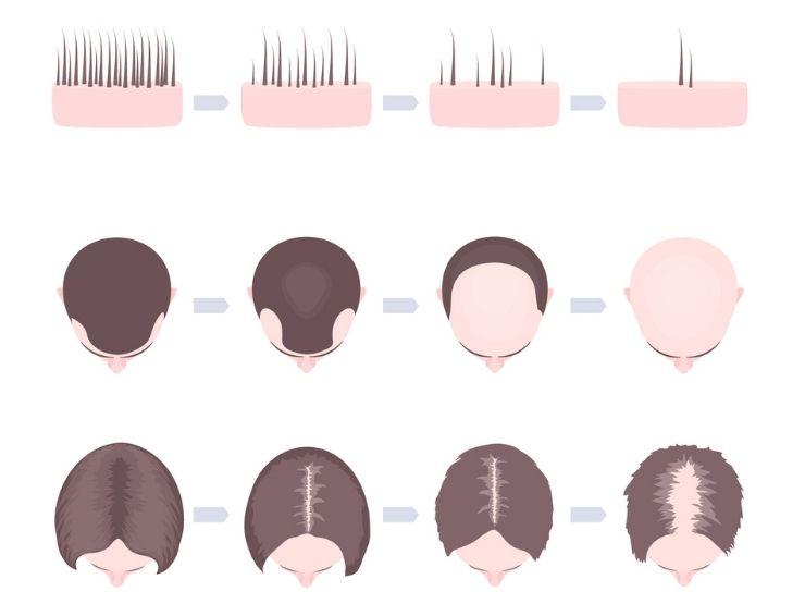 Haarausfall bei jungen Frauen und Männern