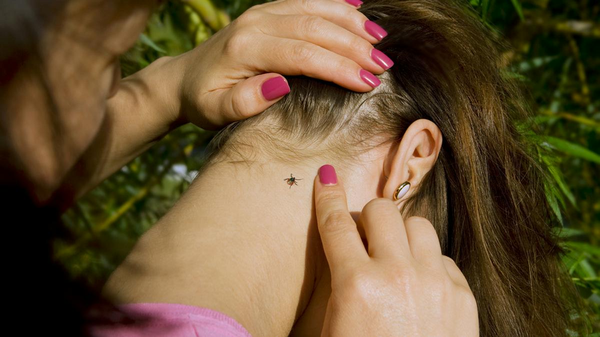 Zecken beißen sich gern am Haaransatz fest.. © Kalcutta / Shutterstock.com