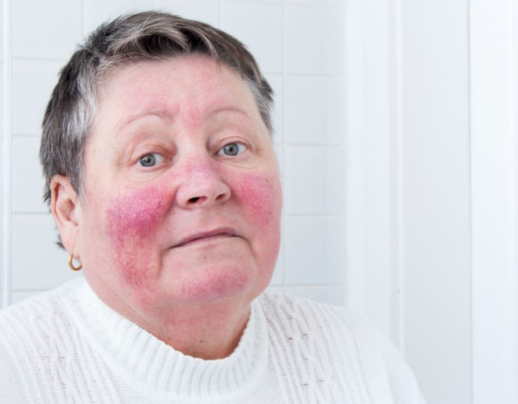 Frau Rosacea