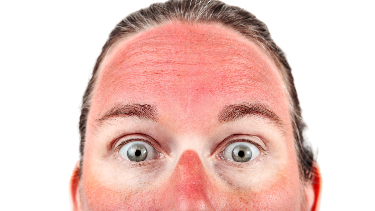 Witzige & schmerzhafte SonnenbrandFails wmn