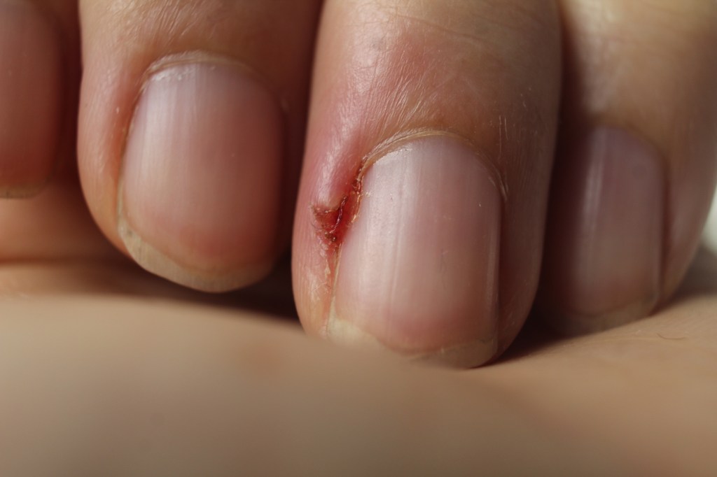 Verletzung am Finger 