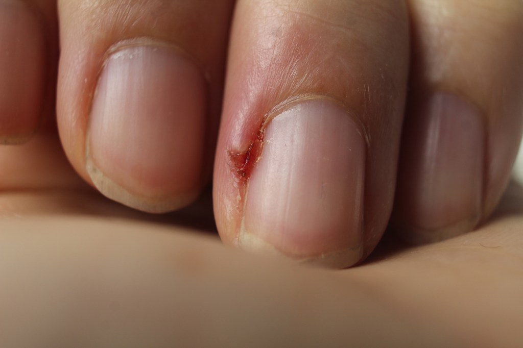 Verletzung am Finger 